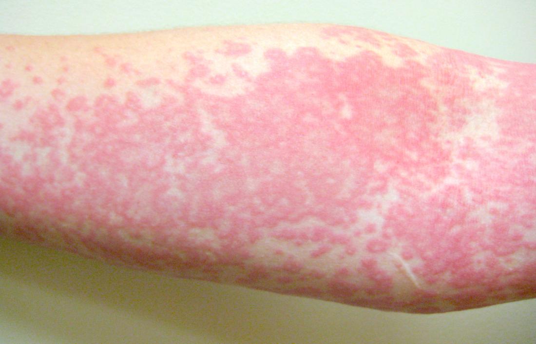 Chlorine rash develops when some swimmers come in contact with chlorine . This condition is also known as "irritant contact dermatitis".